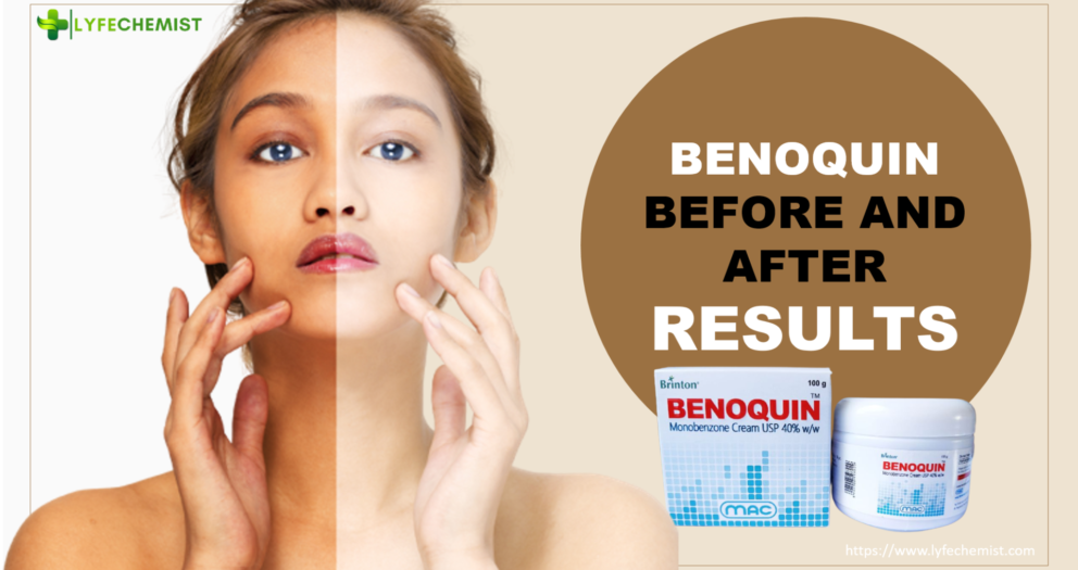 Benoquin before and after results