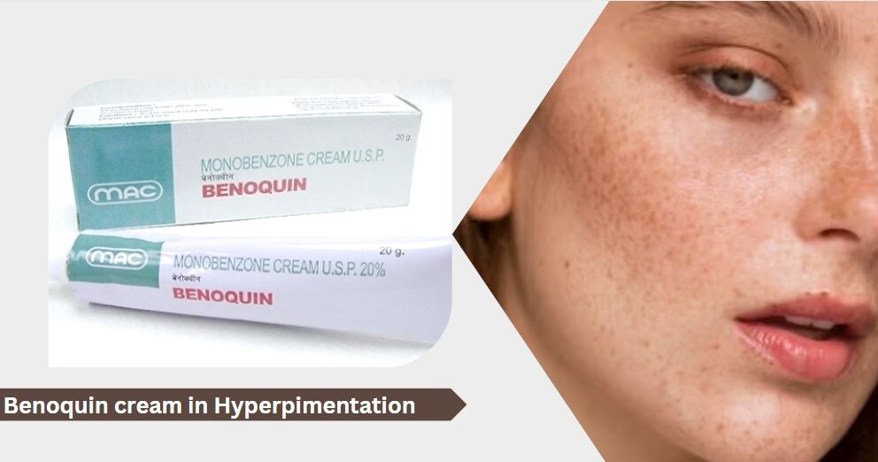 benoquin Cream in hyperpigmentation