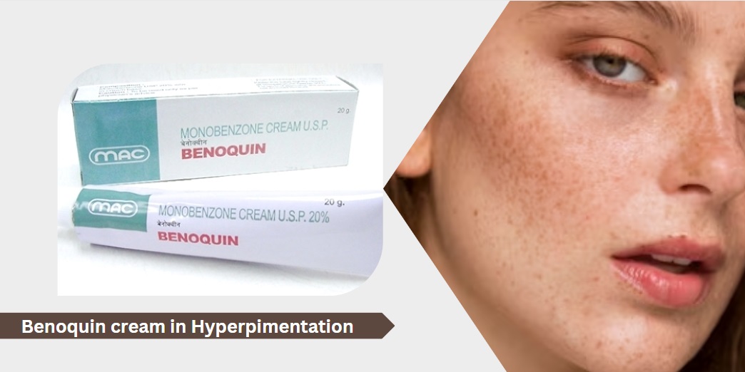 benoquin Cream in hyperpigmentation